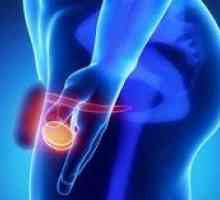 Rakovina semenníkov u mužov: príznaky a liečba