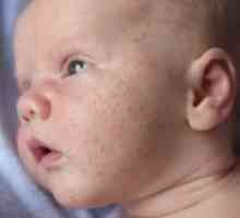 Rôzne typy vyrážok u novorodencov a ich hlavné rozdiely