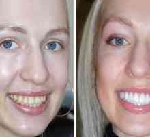 Obnova zubov: hlavné typy a koľko to bude stáť