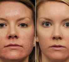 Retinoický peeling: moderné ošetrenie tváre