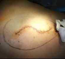 Seróma chirurgického stehu na brušnej dutine