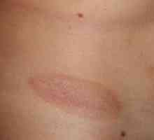 Škvrnitá červená škvrna na tele: časté ochorenia