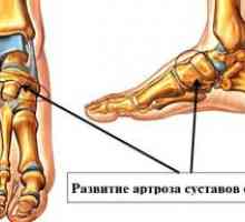 Príznaky artrózy a kĺbov nohy s fotografiami