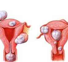 Symptómy fibroidu maternice a spôsoby liečenia nádoru