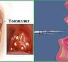 Symptómy chronickej tonzilitídy u detí - jej liečba a prevencia