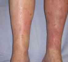 Príznaky a liečba dermatitídy na nohách, foto
