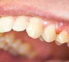 Symptómy a liečba chronickej parodontitídy