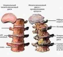 Symptómy a liečba osteochondrózy bedrovej chrbtice