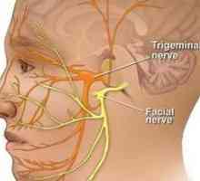 Symptómy a liečba zápalu trojklaného nervu