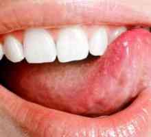 Príznaky a príznaky rakoviny jazyka