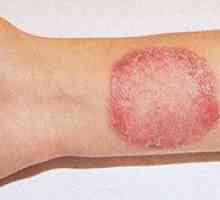 Symptómy mykózy kože a liečba tejto choroby