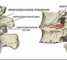 Príznaky osteochondrózy hrudnej oblasti: znaky, príznaky degenerácie