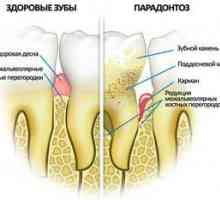 Príznaky ochorenia parodontu a ako ju liečiť doma