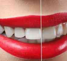 Koľko stojí laserové bielenie zubov?