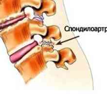 Spondylóza lumbosakrálnej chrbtice: liečba