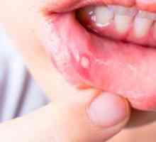 Stomatitída u detí: ako liečiť túto chorobu?