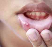 Stomatitída v ústach: kvôli tomu, čo sa stane a ako sa má liečiť