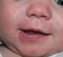 Vyrážky okolo úst dieťaťa: príčiny vzhľadu