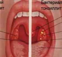 Tonzilitída: príznaky, príznaky, liečba