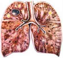 Tuberkulóza: spôsob prenosu, prenosové cesty a príznaky