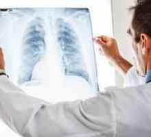 Tuberkulóza: boj proti tuberkulóznej baktérii, tyč koch