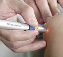 Laserové odstránenie papilómov: výhody, účinky a spätná väzba