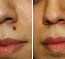 Odstránenie krtkov na tvári: základné metódy a fotografie