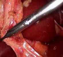 Odstránenie žlčníka: video operácia laparoskopia
