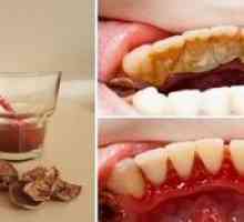 Odstránenie zubného kamene doma