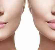 Kozmetické injekcie: rozšírenie pery Botoxom
