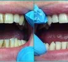 Ultrazvukové čistenie zubov na odstránenie plaku a zubného kameňa