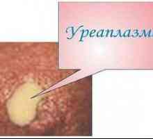 Ureaplazmóza u mužov a žien: liečba a symptómy
