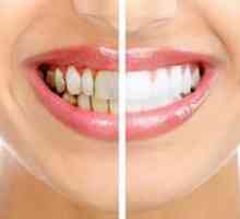 Eliminácia zubného povlaku doma: metódy a odporúčania