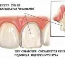 Dyhy na zuby: čo to je, typy, popis a ako ich dať