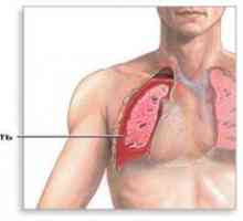 Voda v pľúcach: príčiny, dôsledky, liečba