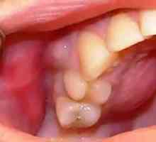 Zápal periostitu zuba: liečba, príznaky periostitis