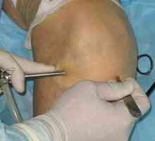 Obnova po operácii artroskopie kolenného kĺbu: recenzie