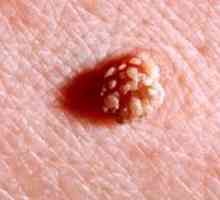 HPV: znaky manifestácie ľudského papilomavírusu, čo to je?