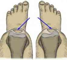 Vrodená patológia kolenného kĺbu - dysplázia