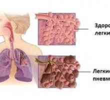 Všetko o pľúcnej fibróze: ako liečiť fibrózne zmeny v pľúcach