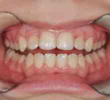 Vyrovnanie zubov u dospelých a detí bez podložiek