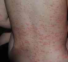 Vyrážky na koži s ochorením pečene, čo sú?
