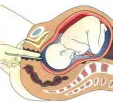 Aká je potreba punkcie močového mechúra pred pôrodom