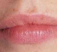 Záchvaty v rohoch úst: príčiny vzhľadu a liečby