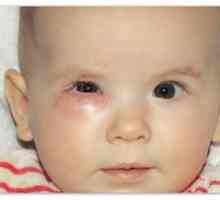 Zastrešenie slzných kanálov u novorodencov: príčiny a liečba