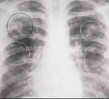 Je tuberkulóm pľúc a aké sú dôsledky?