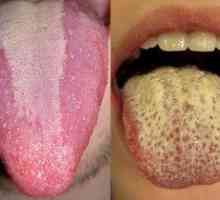 Žltá plaketa v jazyku dospelého - aké ochorenie
