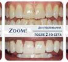 Zoom 4 - nové a bezpečné zuby na bielenie