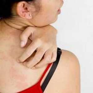 Birchová alergia: príznaky, liečba, krížové produkty