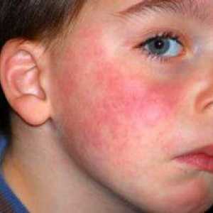 Alergia na mlieko u dieťaťa, príznaky a vývoj